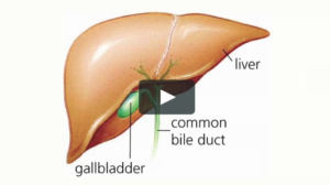 Diet After Gallbladder Removal or Surgery